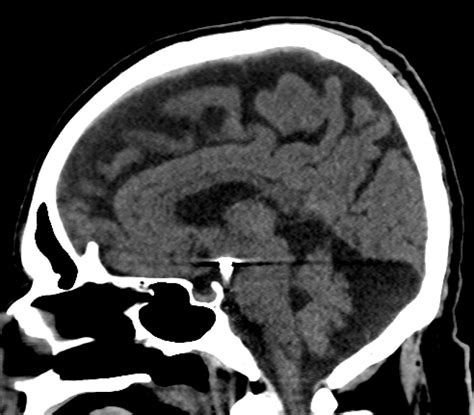 is cisterna magna dangerous|Psychiatric Manifestations Associated With Mega Cisterna Magna.
